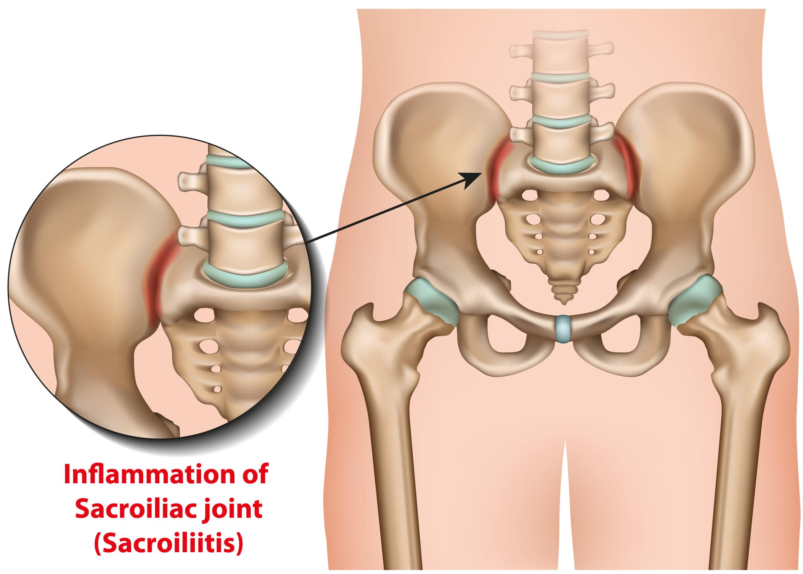 sacroiliitis treatment maple grove