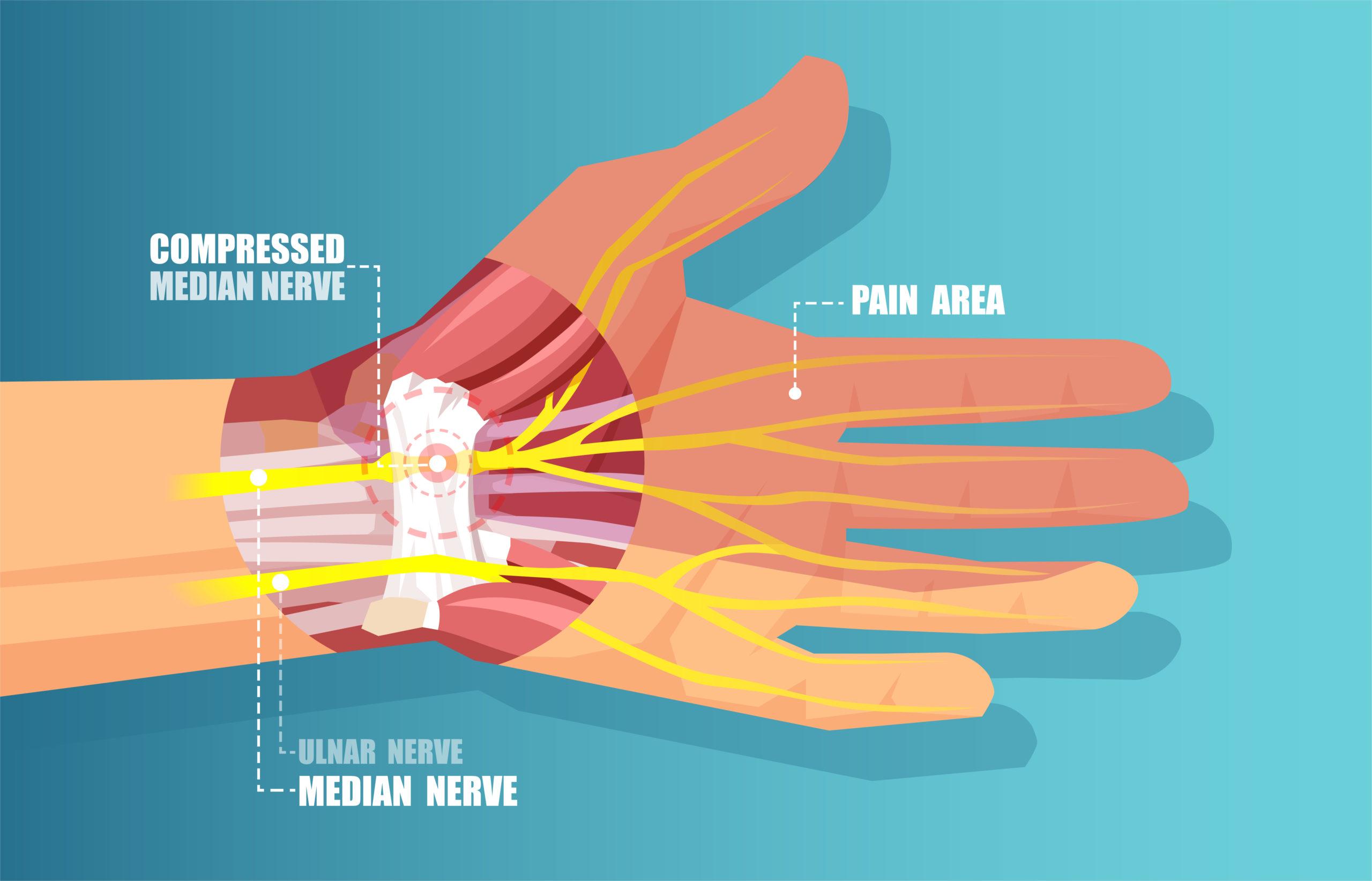 Carpal Tunnel Syndrome Maple Grove