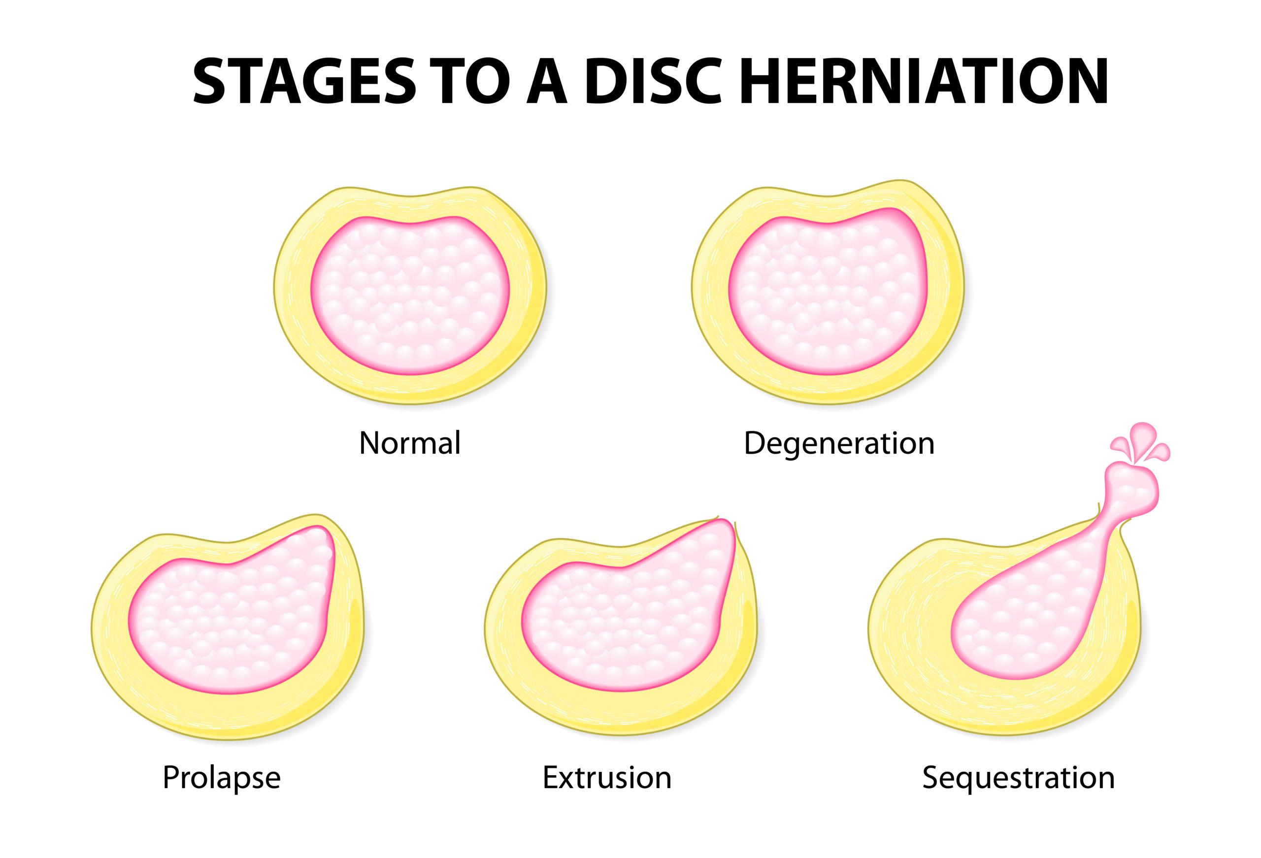 Disc Herniation Treatment Maple Grove