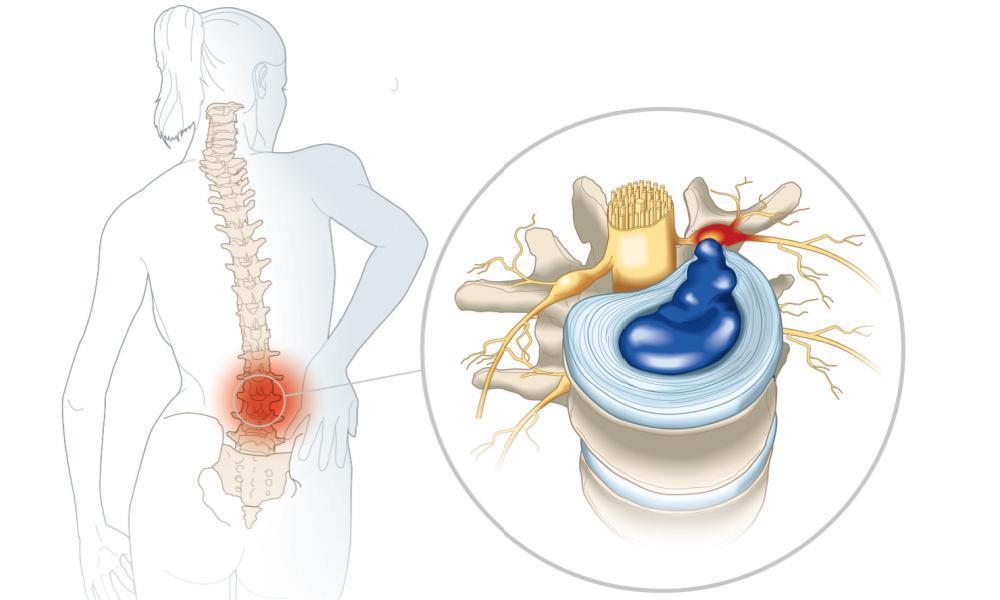 Herniated Disc Treatment St. Francis, MN | Chiropractic Adjustment | Disc Injury Treatment Near St. Francis