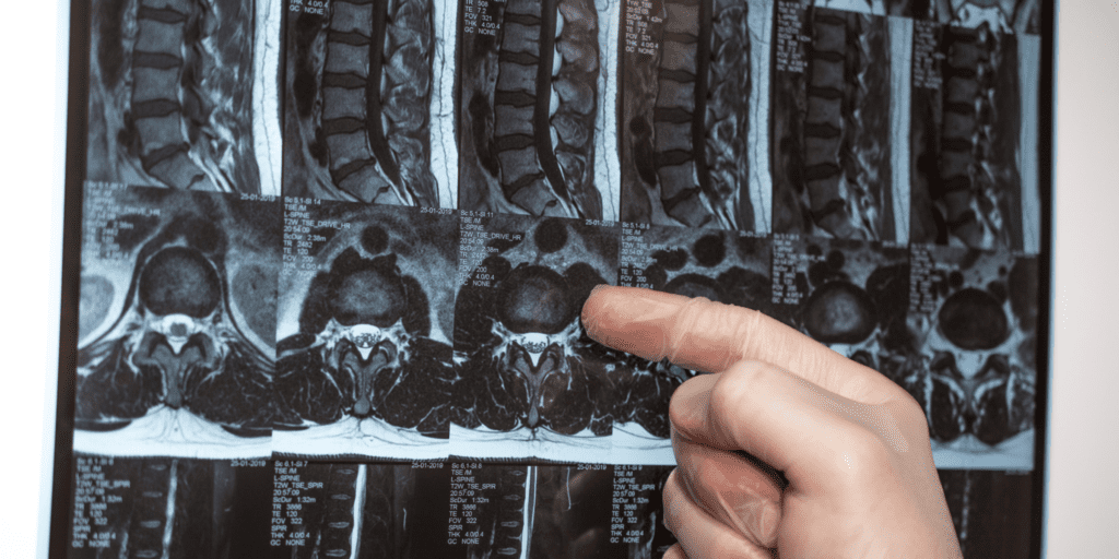 x-ray of whiplash injury