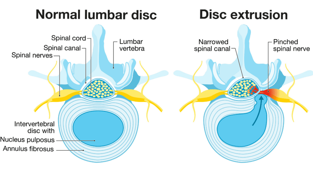 Bulging disc diagram